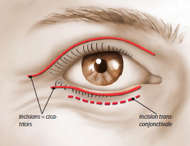 Chirurgie esthétique des paupières ou blépharoplastie