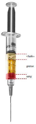 Lipostructure ou réinjection de graisse autologue