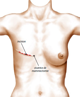 Reconstruction mammaire
