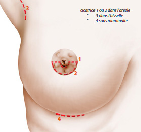 Schéma d'une augmentation mammaire avec prothèses