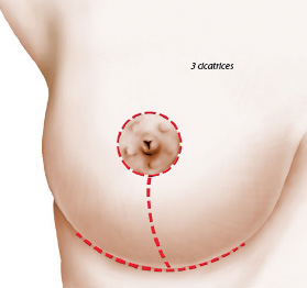 Schéma d'une réduction mammaire hypertrophie