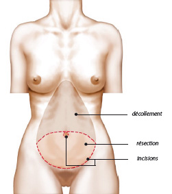 Schéma abdominoplastie