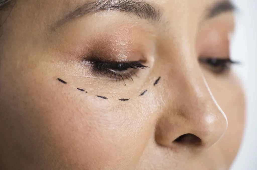 Chirurgie de la paupière inférieure et des poches sous les yeux