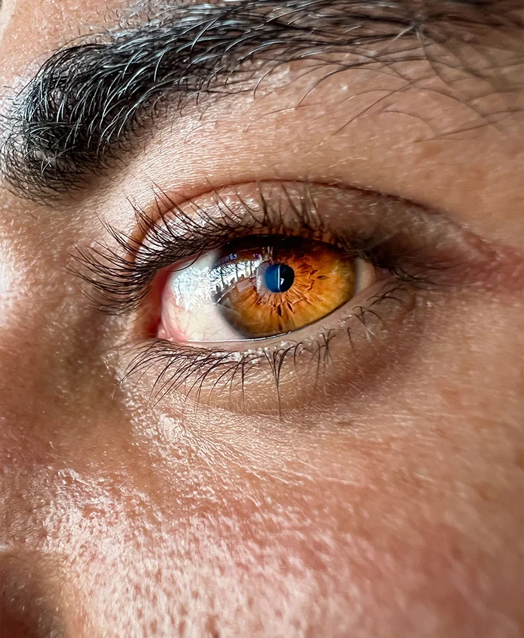 Blépharoplastie inférieure et rajeunissement du regard