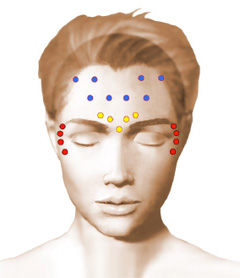 Schéma injection Botox, traitement des rides