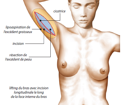Schéma lifting des bras