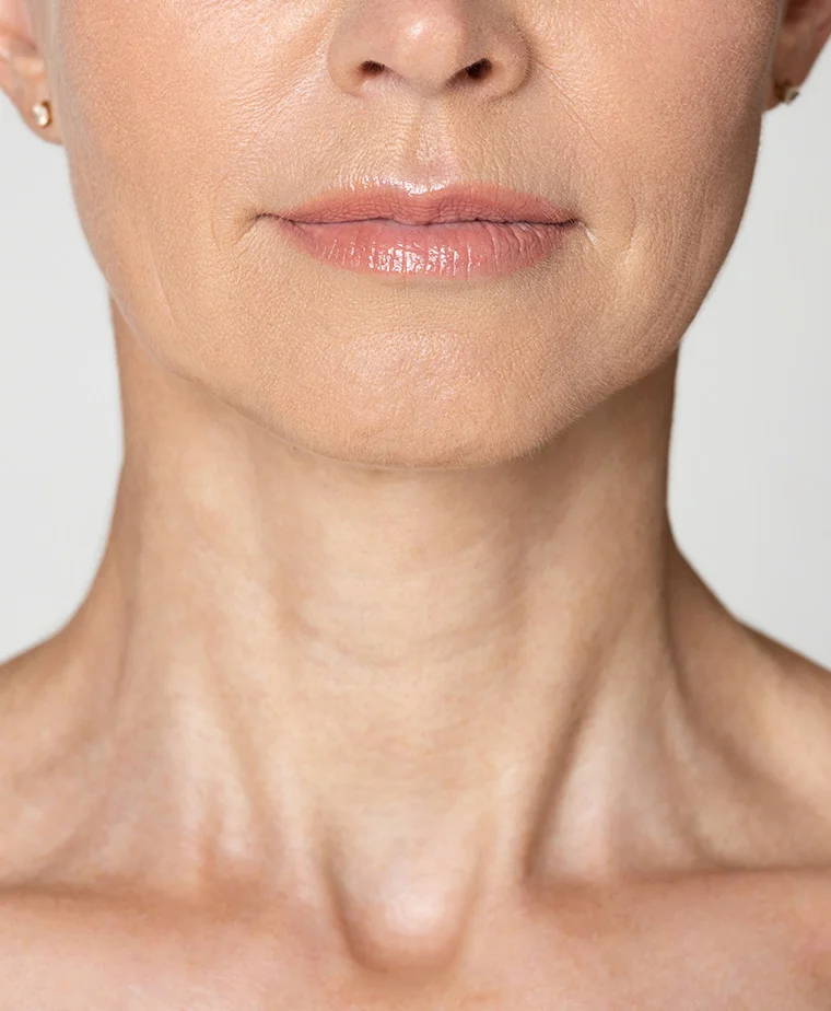 Lifting cervico-facial pour traiter le relâchement du visage et du cou