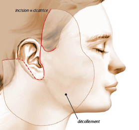 Schéma lifting cervico facial