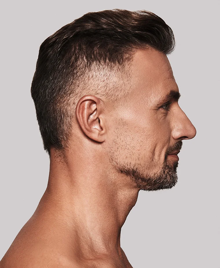 Mini-lifting du visage et correction du relâchement cutané