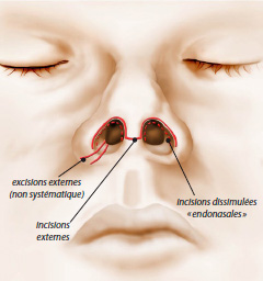 Schéma rhinoplastie du nez