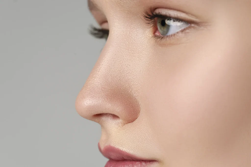 Rhinoplastie médicale par injection d'acide hyaluronique