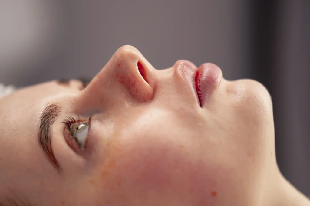 Rhinoplastie secondaire pour corriger les suites d'une première rhinoplastie